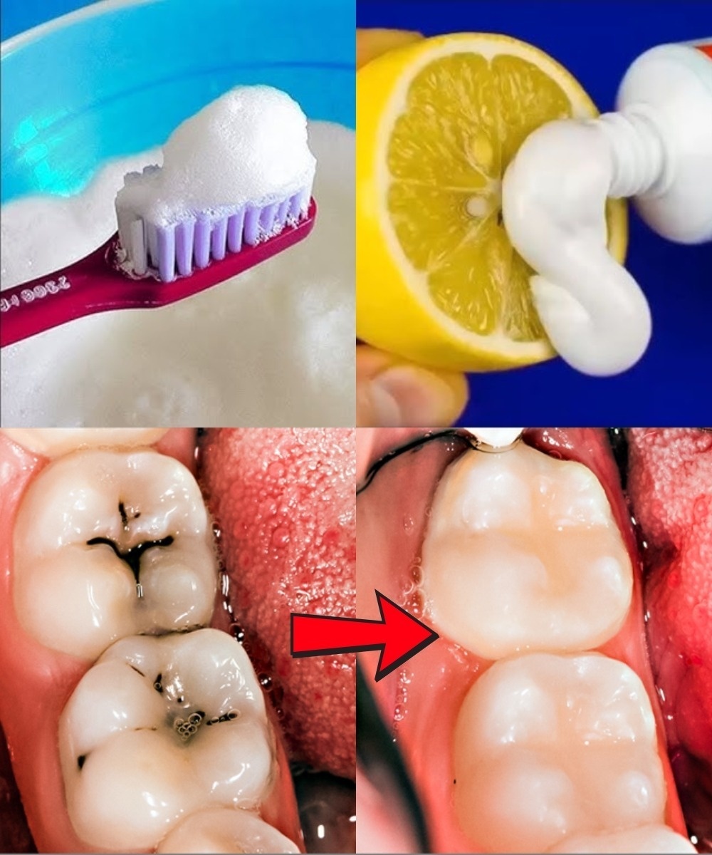 Fix Cavities Naturally? These 6 Dentist-Free Hacks Could Save Your Smile!